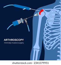 Shoulder arthroscopy procedure. Rotator cuff tears or shoulder impingement. Minimally invasive surgery. Arthroscopic joint treatment, pain and inflammation in human body x ray flat vector illustration