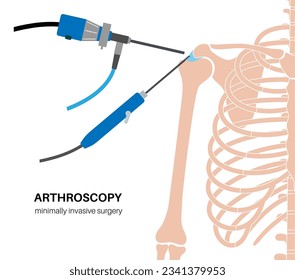 Shoulder arthroscopy procedure. Rotator cuff tears or shoulder joint replacement. Minimally invasive surgery. Ligaments treatment, tendonitis pain or arthritis inflammation medical vector illustration