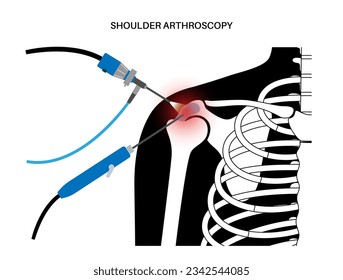 Shoulder arthroscopy procedure. Rotator cuff tears or shoulder impingement. Minimally invasive surgery. Arthroscopic joint treatment, pain and inflammation in human body x ray flat vector illustration