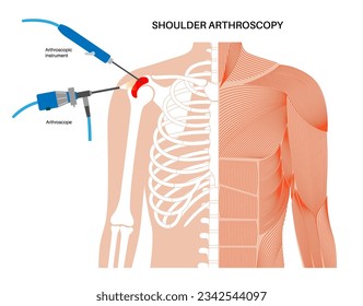 Shoulder arthroscopy procedure. Rotator cuff tears, shoulder muscles problem. Minimally invasive surgery. Arthroscopic joint and ligaments treatment, pain or inflammation in the human body flat vector