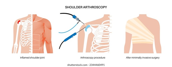 Shoulder arthroscopy procedure. Rotator cuff tears, shoulder muscles problem. Minimally invasive surgery. Arthroscopic joint and ligaments treatment, pain or inflammation in the human body flat vector