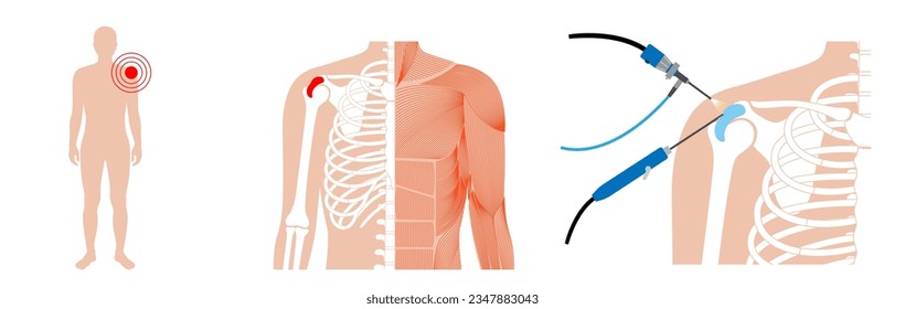 Shoulder arthroscopy procedure. Rotator cuff tears, shoulder muscles problem. Minimally invasive surgery. Arthroscopic joint and ligaments treatment, pain or inflammation in the human body flat vector