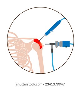 Procedimiento de artroscopía de hombro. Descompresión subacromial, bursitis o reemplazo de las articulaciones de los hombros. Cirugía mínimamente invasiva. Inflamación por dolor o artritis en la ilustración del vector médico del cuerpo humano