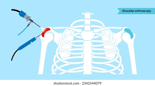 Shoulder arthroscopy procedure. Subacromial decompression, bursitis or shoulder joint replacement. Minimally invasive surgery. Pain or arthritis inflammation in human body medical vector illustration