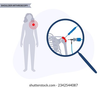 Shoulder arthroscopy procedure. Subacromial decompression, bursitis or shoulder joint replacement. Minimally invasive surgery. Pain or arthritis inflammation in human body medical vector illustration