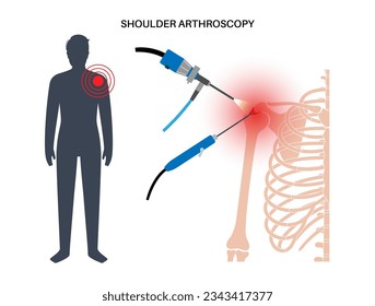 Shoulder arthroscopy procedure. Subacromial decompression, bursitis or shoulder joint replacement. Minimally invasive surgery. Pain or arthritis inflammation in human body medical vector illustration