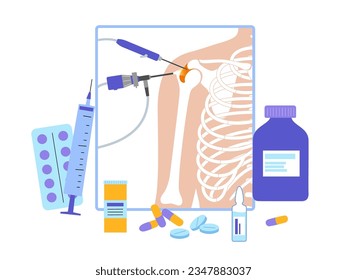 Shoulder arthroscopy procedure. Subacromial decompression, bursitis or shoulder joint replacement. Minimally invasive surgery. Pain or arthritis inflammation in human body medical vector illustration