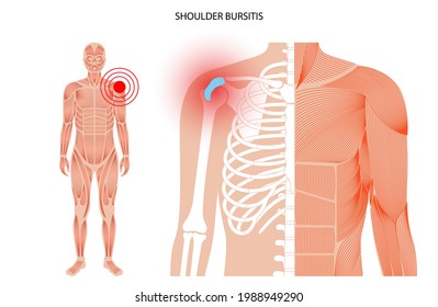 Shoulder bursitis inflammation. Inflamed bursa in the human body. Rotator cuff disease, pain and deformity. Anatomical musculoskeletal poster for clinic or hospital. Medical banner vector illustration