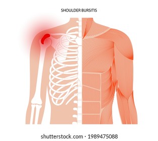 Shoulder bursitis inflammation. Inflamed bursa in the human body. Rotator cuff disease, pain and deformity. Anatomical musculoskeletal poster for clinic or hospital. Medical banner vector illustration