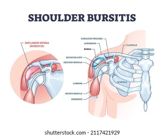 Schulterbursitis als medizinisch schmerzhafte Bursa Entzündung Rahmendiagramm. Beschreibung von gekennzeichneten Krankheiten mit anatomischer Struktur und Beschreibung von inneren Körperverletzungen Vektorgrafik