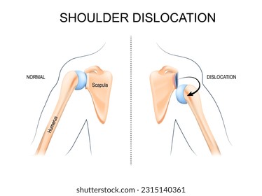 Shoulder dislocation. humerus bone trauma, Sports injuries, or Weak shoulder muscles. Human arm anatomy. Bones and joint of the Shoulder, and hand. Vector illustration