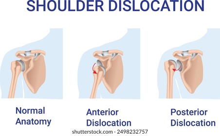 Shoulder Dislocation, normal anatomy, anterior Dislocation and posterior dislocation illsutration