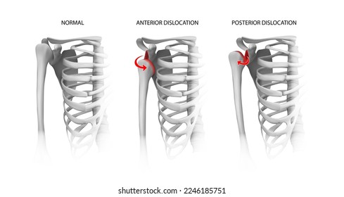 Shoulder dislocation options. Vector illustration.