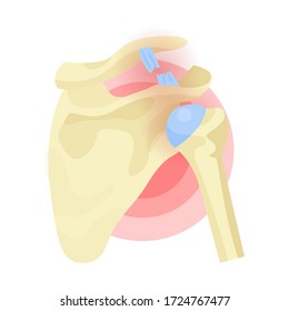 Schulterverlagerung, Sehnenriss, Bänder, Gelenke, Gelenkprolapse. Schmerzstelle Skelettmuskulatur-Trauma, Verletzung. Orthopädische, anatomisch-medizinische Vektorgrafik isoliert auf Weiß.