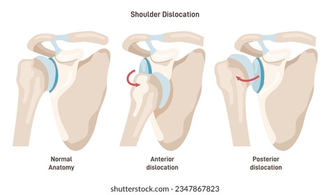 Shoulder dislocation types. Arm injury, upper arm bone pops out of the cup-shaped socket of shoulder blade. Glenohumeral joint dislocation. Flat vector illustration