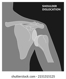 Shoulder dislocation X-ray joint arm sport lesion slap hill sachs tear torn traumatic pain broken cuff sling bone falls tendon subluxed head range of motion Superior overuse clavicle separated therapy