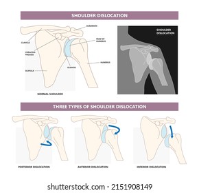 Shoulder dislocation X-ray joint arm sport lesion slap hill sachs tear torn traumatic pain broken cuff sling bone falls tendon subluxed head range of motion Superior overuse clavicle separated therapy