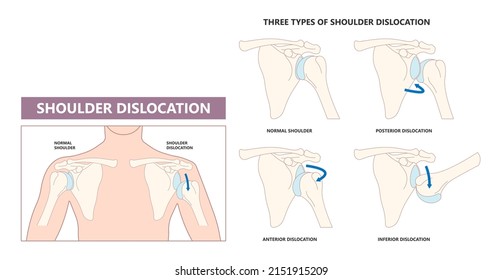 Shoulder dislocation X-ray joint arm sport lesion slap hill sachs tear torn traumatic pain broken cuff sling bone falls tendon subluxed head range of motion Superior overuse clavicle separated therapy