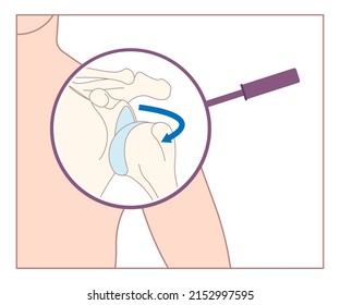 Shoulder dislocation X-ray joint arm sport lesion slap hill sachs tear torn traumatic pain broken cuff sling bone falls tendon subluxed head range of motion Superior overuse clavicle separated therapy