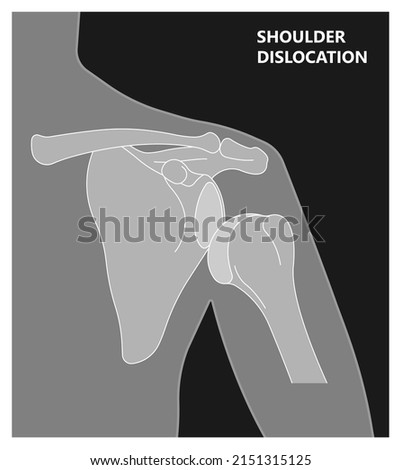 Shoulder dislocation X-ray joint arm sport lesion slap hill sachs tear torn traumatic pain broken cuff sling bone falls tendon subluxed head range of motion Superior overuse clavicle separated therapy