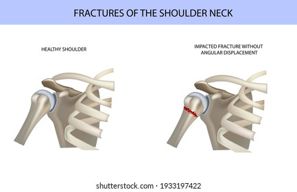 Shoulder fractures, medical vector illustration