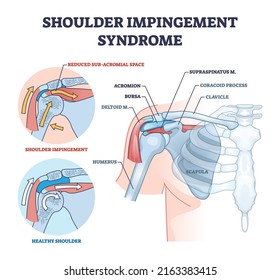 Síndrome de inducción de hombros por frotamiento del diagrama de contorno de la manguera del rotador. Esquema educativo etiquetado con ilustración vectorial de comparación dolorosa y saludable del sistema muscular. Problema del esqueleto del cuerpo superior