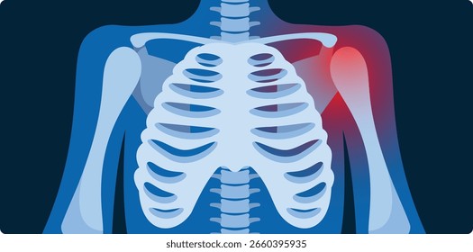 Ilustração de vetor de raios-x de inflamação da articulação do ombro