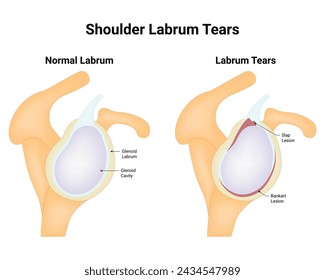 Shoulder Labrum Tears Science Design Vector Illustration Diagram