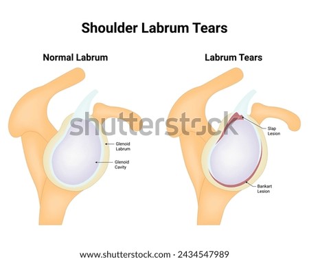Shoulder Labrum Tears Science Design Vector Illustration Diagram