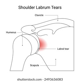 Hombro Labrum Lágrimas Ilustración simple