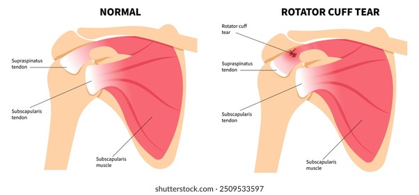 Anatomia dos músculos do ombro que se compara entre tendões lesionados e normais