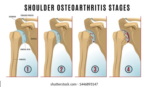 Shoulder Osteoarthritis Stages Infographic. Realistic Bones Scheme. Joint Pain. Editable Vector Illustration Isolated On A White Background. Medical, Healthcare, Elderly Diseases Graphic Concept