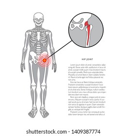 Shoulder prosthesis, vector banner with place for text. Arthritis joint pain syndrome and prosthetics, replacement of human joints. Joint pain. Flat vector illustration