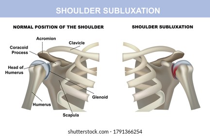 shoulder subluxation, healthy shoulder joint and shoulder joint with subluxation, medical material with symbols