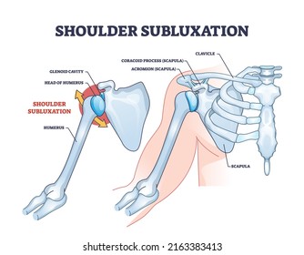 Shoulder subluxation as partial dislocated arm joint problem outline diagram. Labeled educational medical scheme with body skeletal anatomy and dislocated bones vector illustration. Upper body trauma.