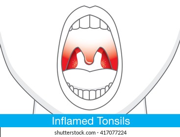 Showing Inflamed tonsils by open mouth. This illustration about health and medical.