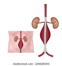 Shunting Of An Aneurysm Of The Abdominal Aorta. Medical Poster, Vector Illustration