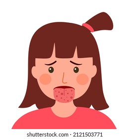 Sick girl with hand foot mouth disease in flat design on white background.