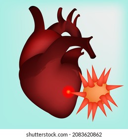 A sick heart with a spiky virus. Medical concept. Vector illustration.