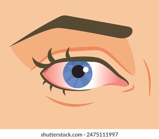 
Sick Red Eye Vector Cartoon illustration Design. Person with symptoms of conjunctivitis due to allergies 
