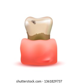 Sick and rotten realistic human tooth with caries in sore gum on white