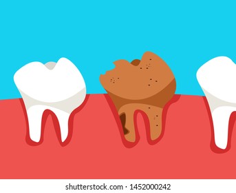 Sick tooth. Oral cavity with a tooth deteriorated from metal corrosion. Flat vector illustration in cartoon style.