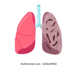 Sick Unhealthy Lungs Tuberculosis Infection Disease. Human Respiratory System Internal Organ Tubercle Bacillus Infected Or Pneumonia Struck. Medical Anatomy Inflammation Damage Vector Illusrtation