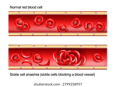 Sickle cell anaemia. Cross section of blood vessel. Sickle cells blocking a blood vessel. Capillaries with normal erythrocytes and Sickle cell disease SCD. hemoglobin mutation. Medical illustration. Infographic diagram. Vector