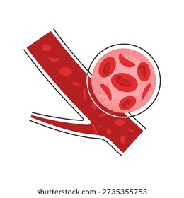 Sickle cell anaemia. Section of vein with erythrocytes in blood. Healthy, round erythrocytes red blood cells alongside distinct sickle shaped or crescent-shaped red blood cells, concept for sickle cell disease, sicklemia trait. Vector flat illustration