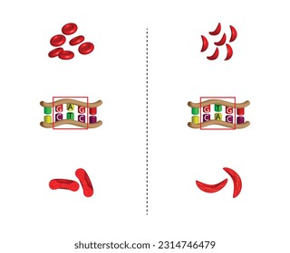 Sichelzellanämie, Krankheit. Erythrozyten und Sichelzellen. Genmutation. Vergleich der DNA-Sequenz zwischen der normalen roten Blutzelle und der Sichelzelle. Vektorgrafik.