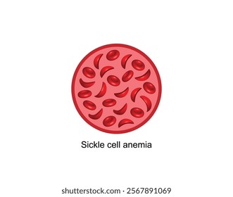 Sickle cell anemia. Gene mutation. Vector scientific illustration isolated on white background.