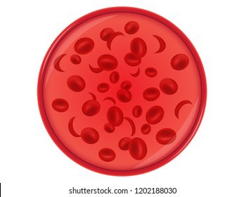 Sickle Cell Anemia, Genetic Diseases