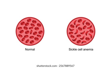 Sickle cell anemia. Normal red blood cells and sickle cell. Gene mutation. Vector illustration.