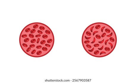 Sickle cell anemia. Normal red blood cells and sickle cells. Gene mutation. Vector illustration.